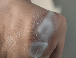 Fototapeta premium The doctor provides first aid for sunburn of the back, aerosol foam medicine