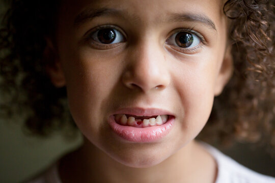 Anxious girl shows mouth with missing tooth
