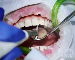 Macro photography. Top view on cleaning process in patient's mouth with cheek retractor and...
