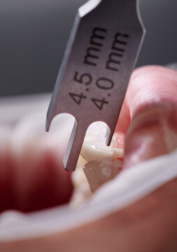 Dental height gauge. Macro photography. Vertical close-up snaphot of a dental measuring tool, teeth with brackets and lower lip with cheek retractor. Concept of dentistry and orthodontic treatment.