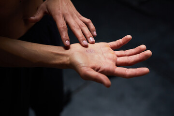A blister on the female's hand.