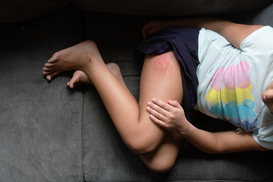 Child with scraped and bruised leg