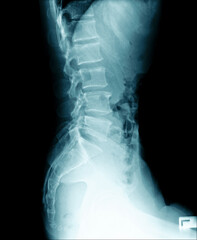 x-ray image of human abdomen, picture of human spine and pelvic bone show degenerative change of spine, low back pain and refer pain to lower limb - obrazy, fototapety, plakaty