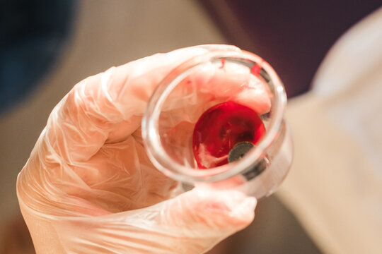Vacuum cup filled with thickened blood