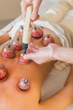 Cupping therapy