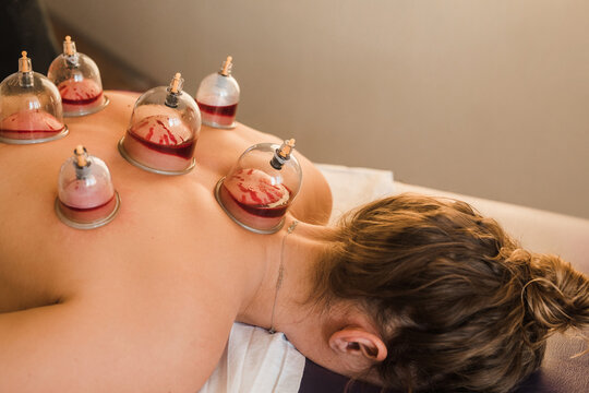 Hijama therapy