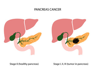 Pancreas disease and cancer