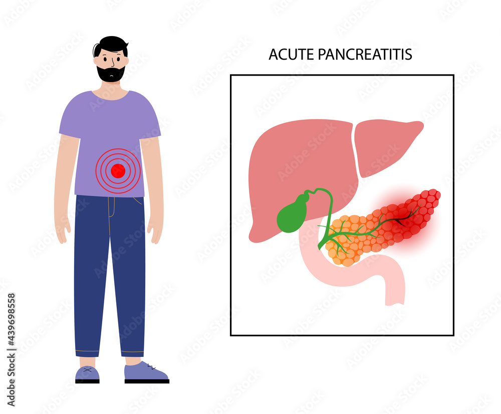 Wall mural Pancreas disease and cancer