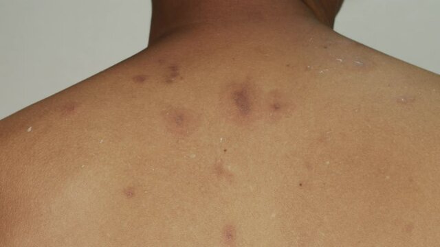 .A 60-year-old man has a blistering rash. There are lymphatic fluids all over the body. .after vaccination against the coronavirus. Caused by an allergic reaction to the COVID-19 vaccine..4k video..