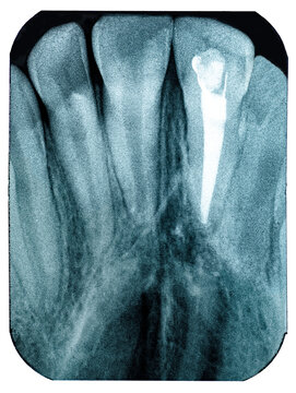 Radiography Imaging Teeth Upper Canines Root Canal