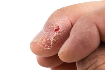 Closeup of painful inflammed damaged dry skin on the finger
