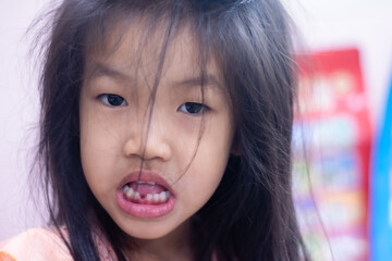 A 5-year-old Asian girl broke her first tooth.