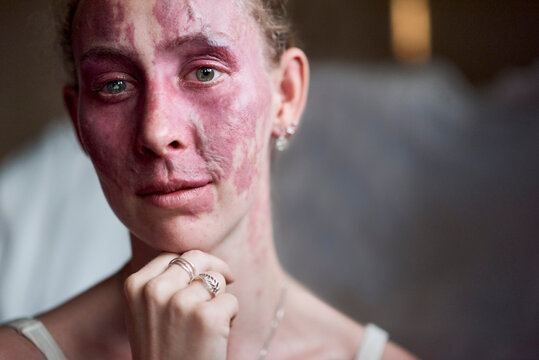 Beauty portrait of a young woman with a facial birthmark 