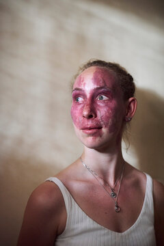 Inspiring portrait of a young woman with a port wine stain birth