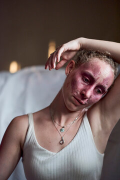 Fashion Portrait Of A Young Woman With A Port Wine Birthmark On 