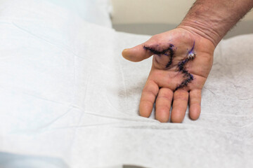 Hand with stitches in palm and thumb to fix Dupuytren's Contracture