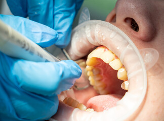 dentist at work, dental procedure