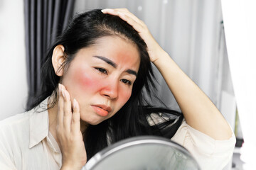 sad Asian woman having problem with sunburn on face , checking her redness skin on a mirror because...