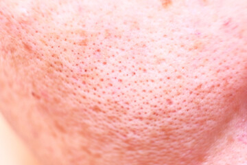 Close up nose on skin and skin care concept and complete skin Solutions large Pores and Blackhead Treatment