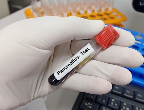 Biochemist or doctor holds blood sample for pancreatitis test, amylase, lipase. Medical test tube in laboratory background.
