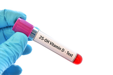 Test tube with blood sample for 25-OH vitamin D or vitamin D2/D3 test, diagnosis for bone disease