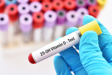 Test tube with blood sample for 25-OH vitamin D or vitamin D2/D3 test, diagnosis for bone disease