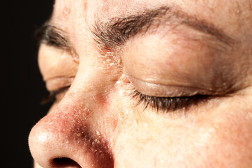 Psoriasis - Schuppenflechte im Gesicht einer Frau
