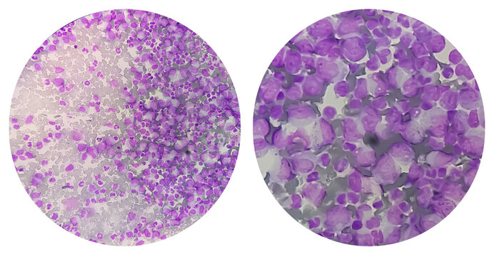 Photomontage of microscopic images show thrombocytopenia with leukocytosis. hematology