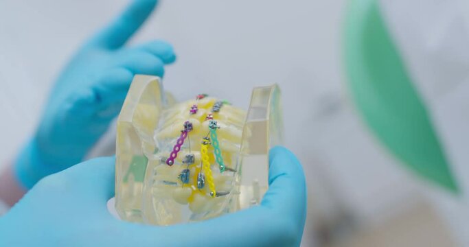 Close-up a jaw model with crooked teeth with a bracket system and elastics is holding a medical worker.
