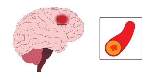 Brain Stroke illustration. Stroke in the frontal lobe of a brain. Stroke caused by atherosclerosis
