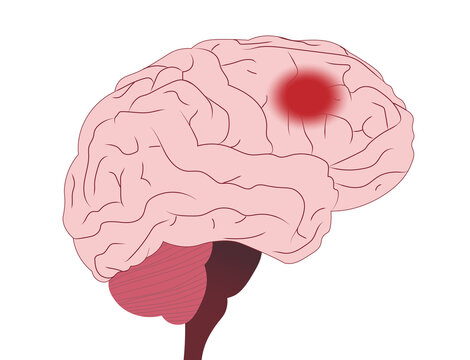 Brain Stroke illustration. Stroke in the frontal lobe of a brain.