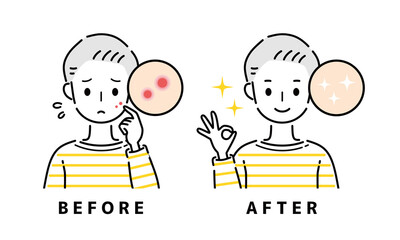 ニキビ　吹き出物　ビフォーアフター