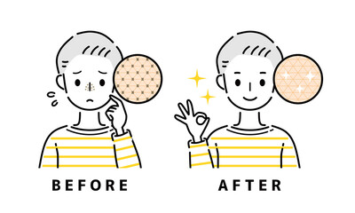 毛穴　鼻　ビフォーアフター