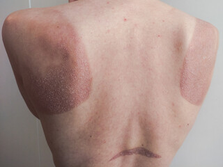 Sunburn on woman's red blistered back	

