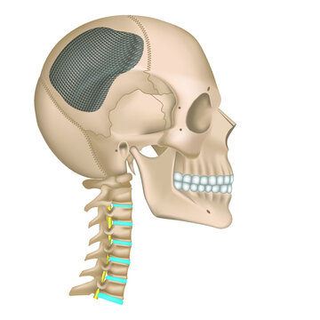 Cranioplasty of the skull. Operation to restore the bones of the head. metal mesh, plate. Human anatomy. Cervical spine Vector illustration.