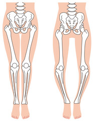 骨盤と骨格　O脚の骨格　骨盤の歪み