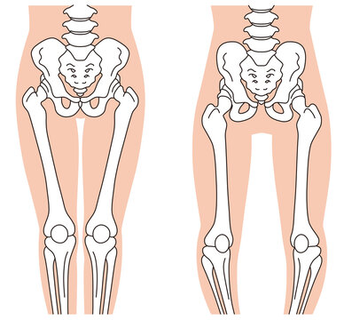 骨盤と骨格　O脚の骨格　骨盤の歪み