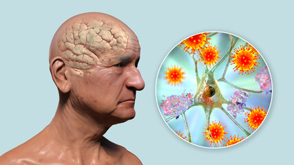 Infectious etiology of dementia. Viruses that affect neurons - obrazy, fototapety, plakaty