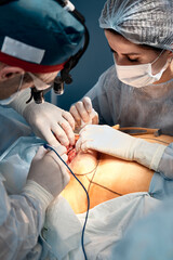 A team of male and female surgeons operate on breast cancer, mammoplasty with plastic...