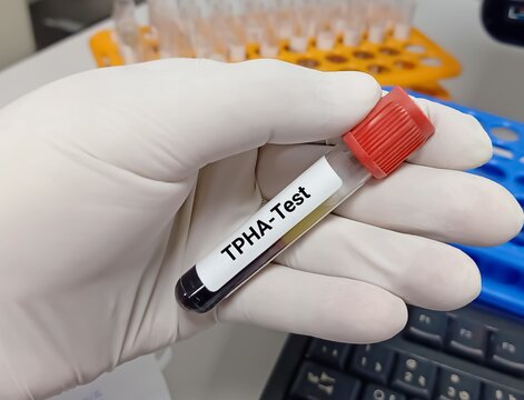 Biochemist or Lab Technologist holds Blood samples for Treponema pallidum hemagglutination (TPHA) test, Syphilis disease diagnosis in the laboratory background.