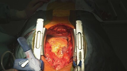 01 JUNE 2021 New York NY USA: Team of surgeons in hospital coronary artery bypass grafting for open heart surgery