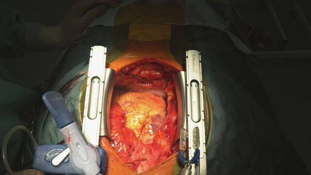 01 JUNE 2021 New York NY USA: Team of surgeons in hospital coronary artery bypass grafting for open heart surgery