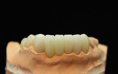 Dental zirconia bridge with porcelain baked