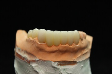 Dental zirconia bridge with porcelain baked