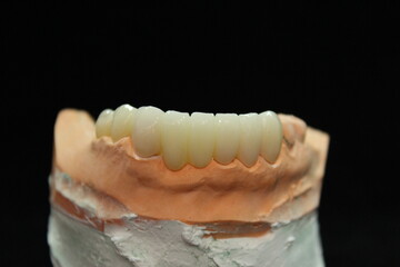 Dental zirconia bridge with porcelain baked