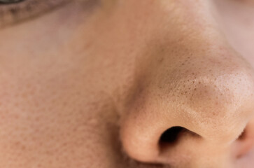 The tip of the nose with clogged skin pores before cleaning procedures.