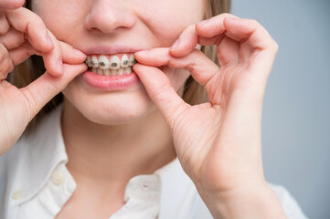 Naklejka premium Close-up portrait of a red-haired girl touching braces. Young woman corrects bite with orthodontic appliance.