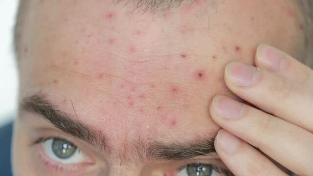 Body of adult  man have spotted, red pimple and bubble rash from chickenpox or varicella zoster virus. Medical complications after illness. Treatment with brilliant green