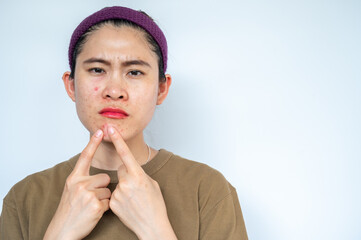 Asian woman pointing to acne inflamed on her face. Inflamed acne consists of swelling, redness, and...
