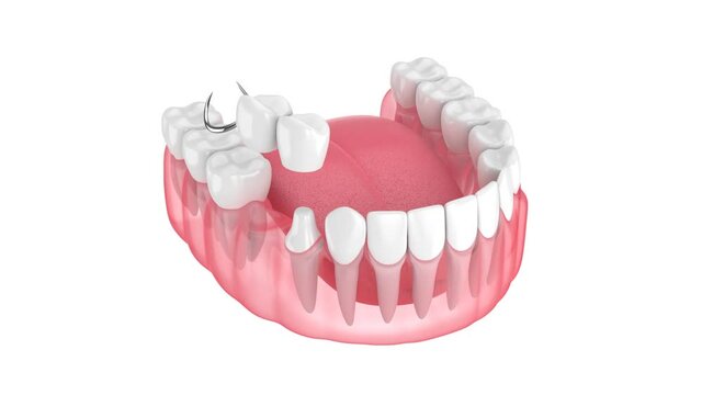 Jaw with removable partial denture isolated over white background